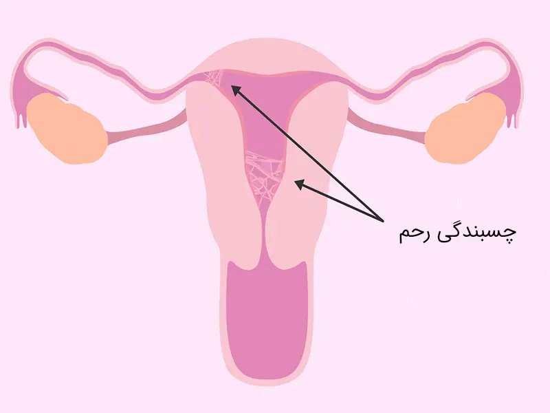 نحوه ایجاد چسبندگی رحم